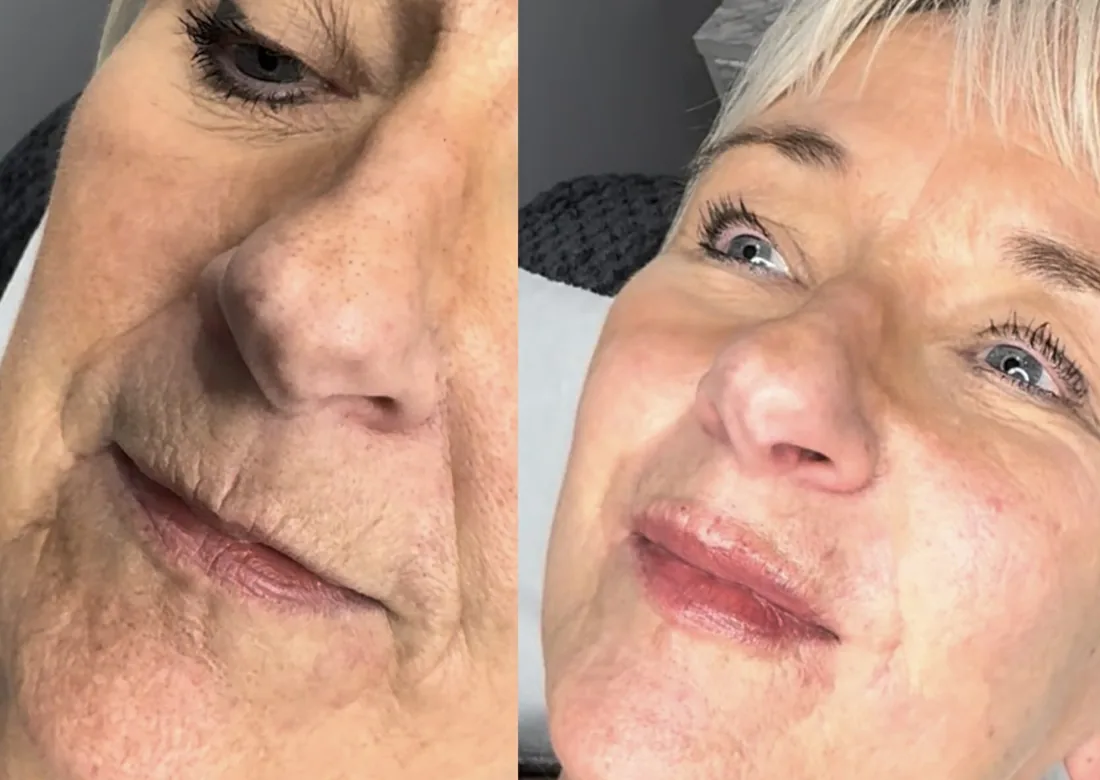 Client comparison photograph 02, published by Refined Medical Aesthetics with permission