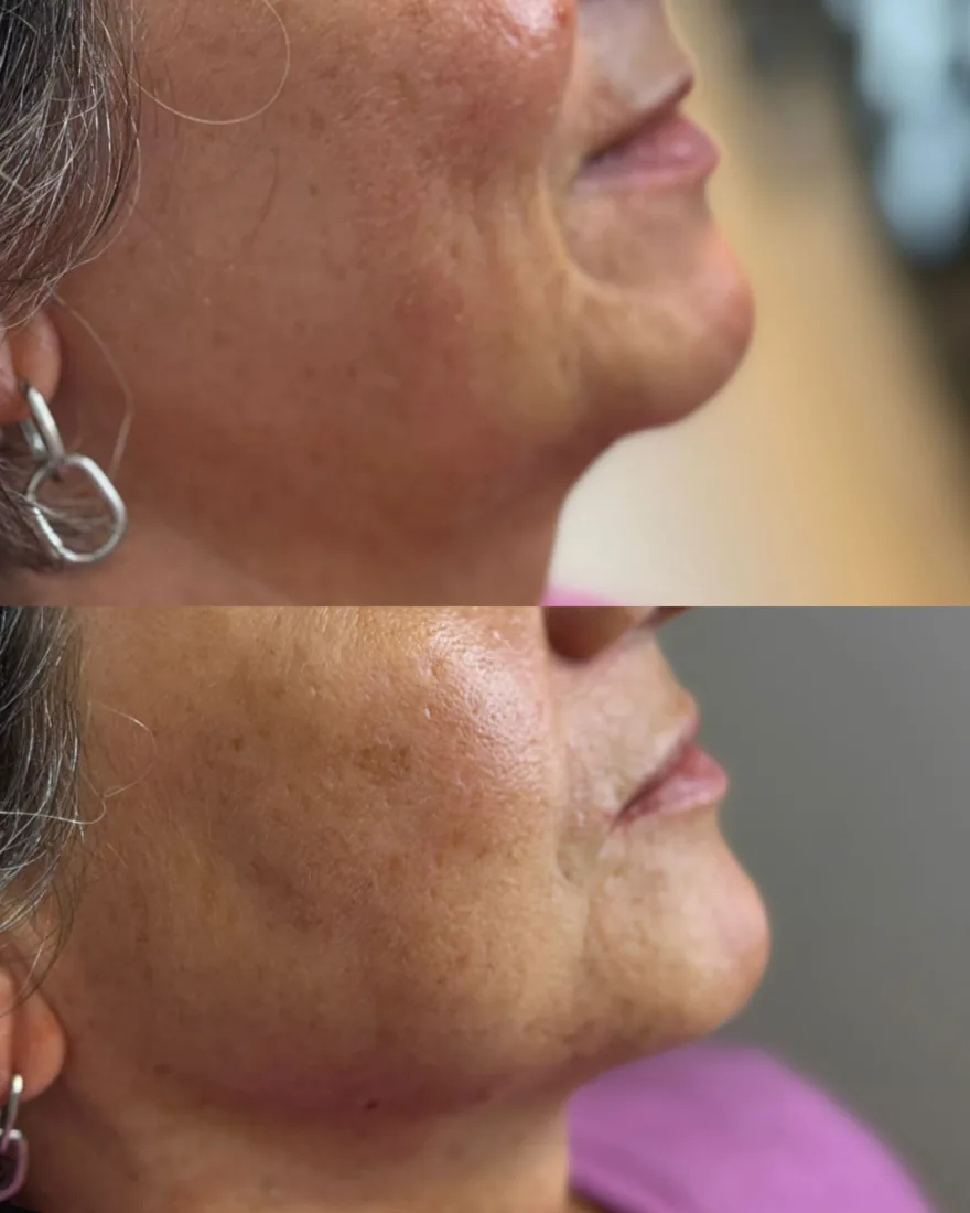 Client comparison photograph 04, published by Refined Medical Aesthetics with permission