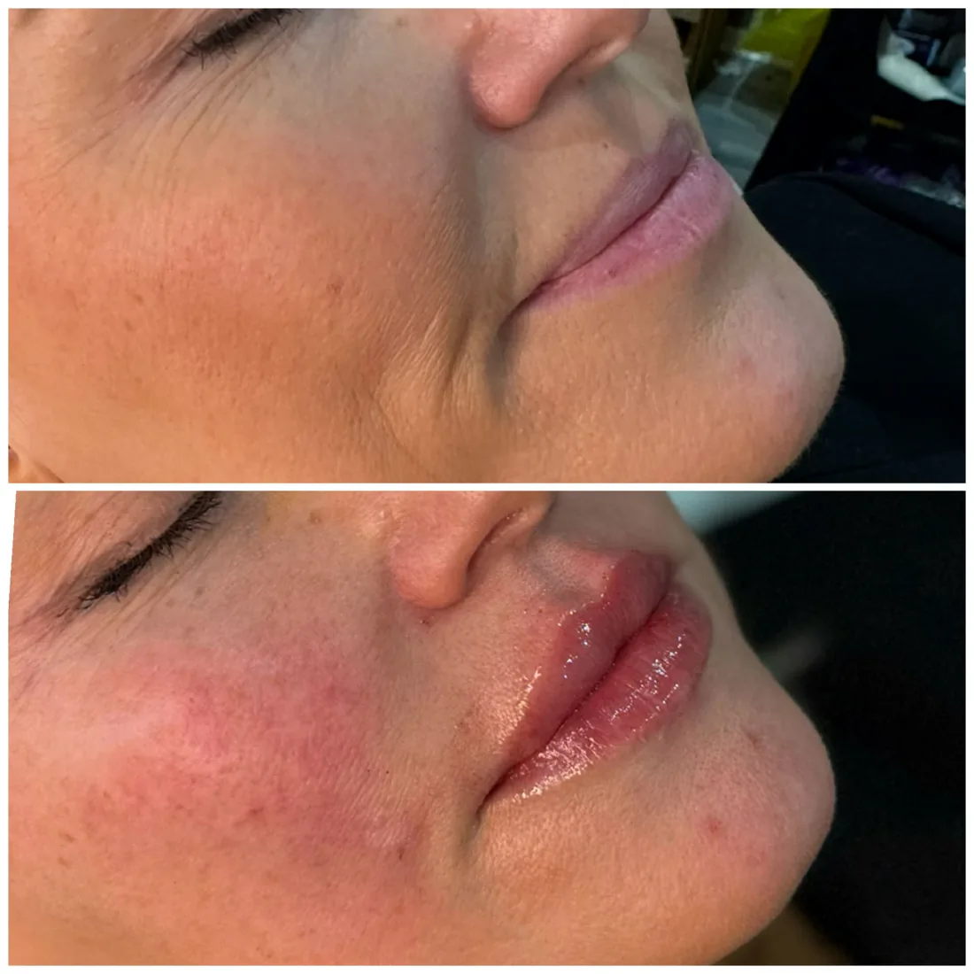 Client comparison photograph 06, published by Refined Medical Aesthetics with permission