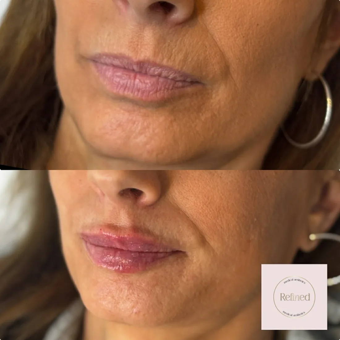 Client comparison photograph 07, published by Refined Medical Aesthetics with permission