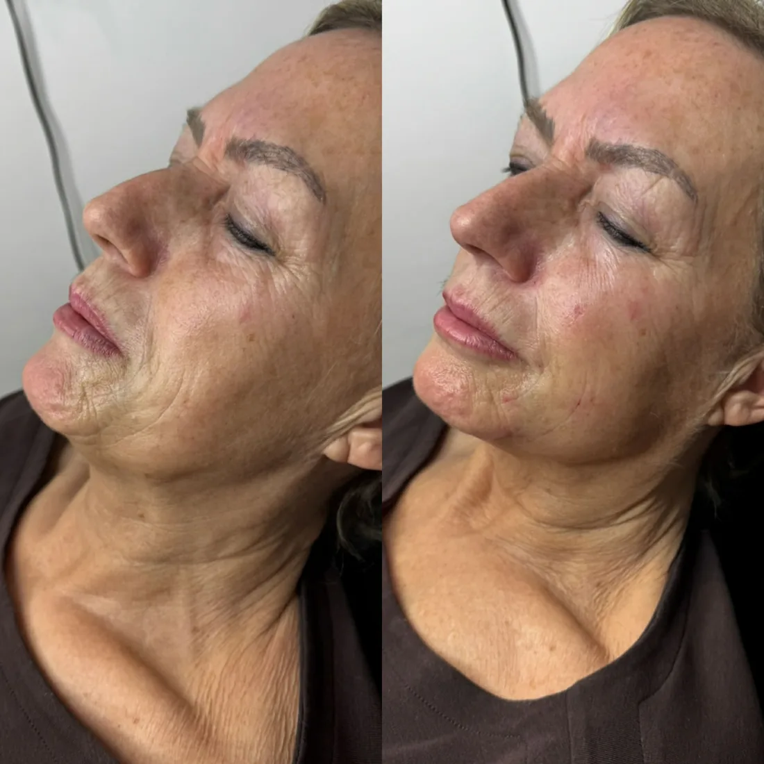 Client comparison photograph 10, published by Refined Medical Aesthetics with permission