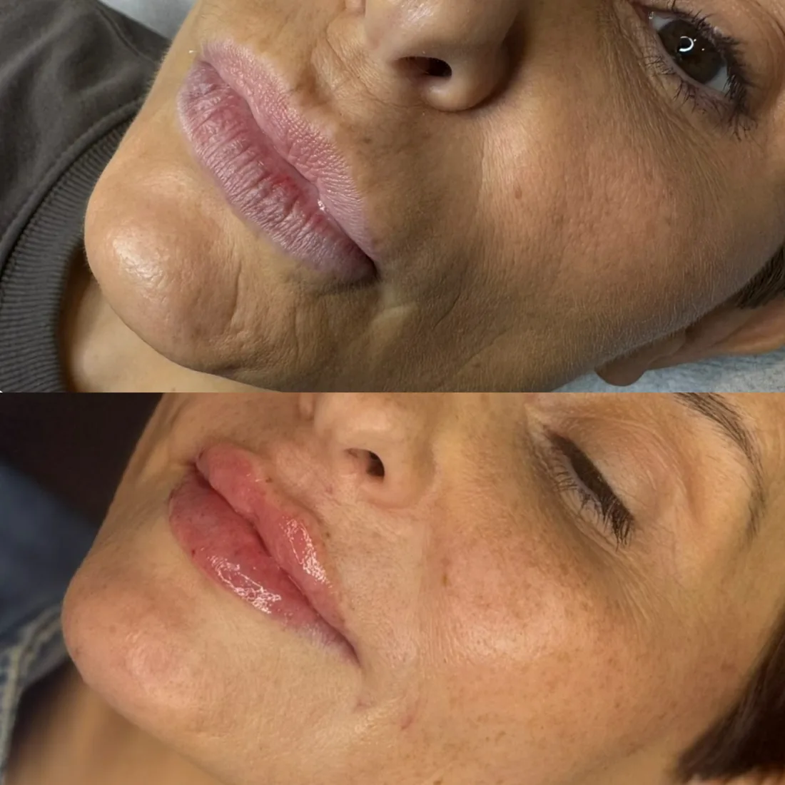 Client comparison photograph 11, published by Refined Medical Aesthetics with permission