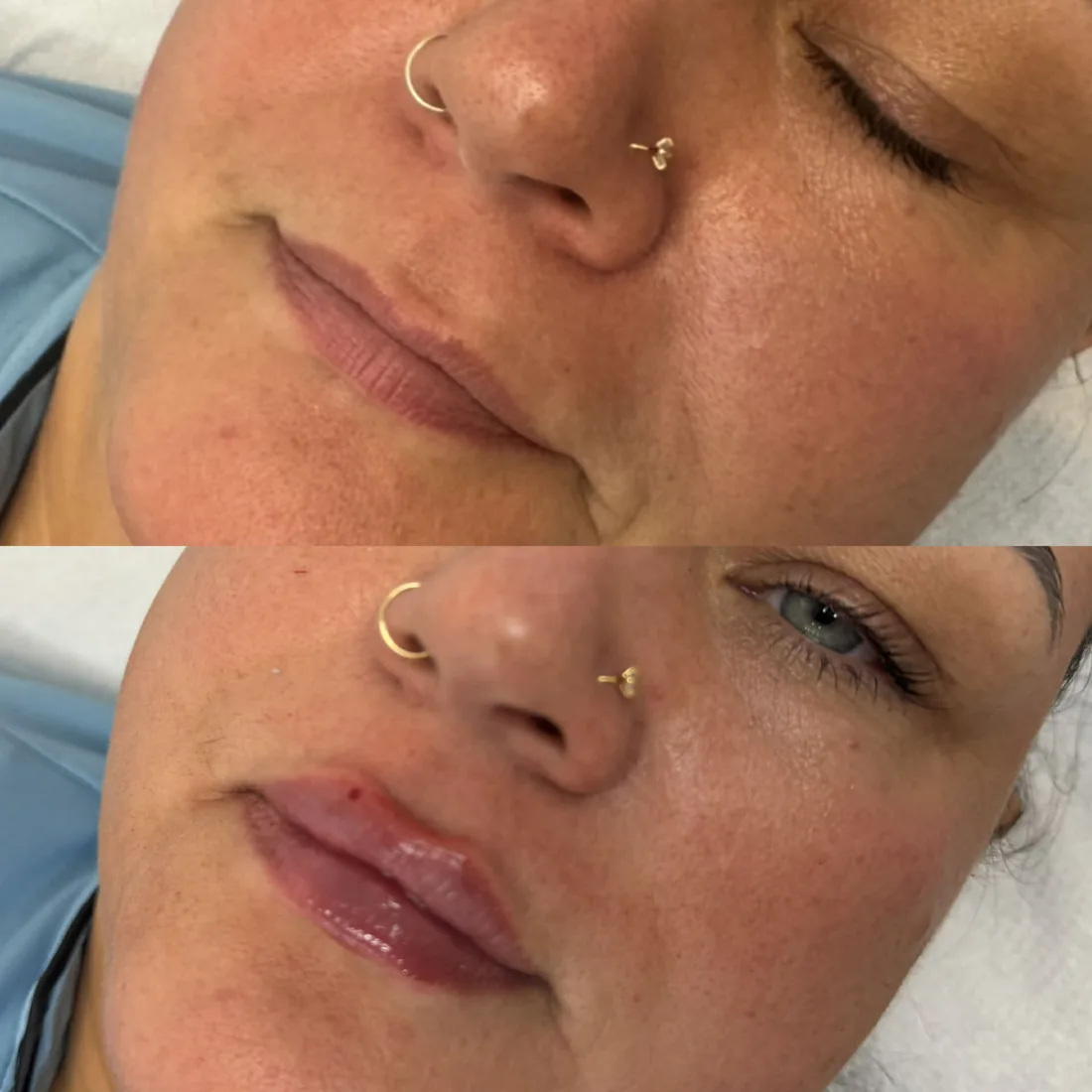 Client comparison photograph 12, published by Refined Medical Aesthetics with permission