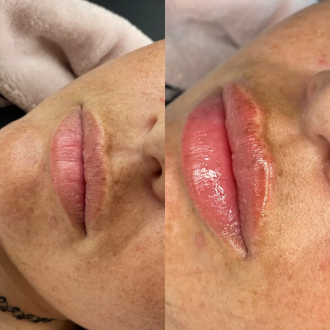 Client comparison photograph 14, published by Refined Medical Aesthetics with permission