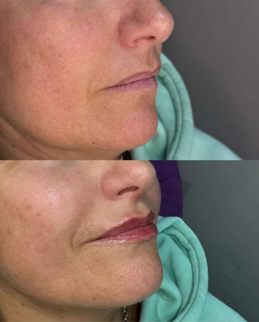 Client comparison photograph 15, published by Refined Medical Aesthetics with permission