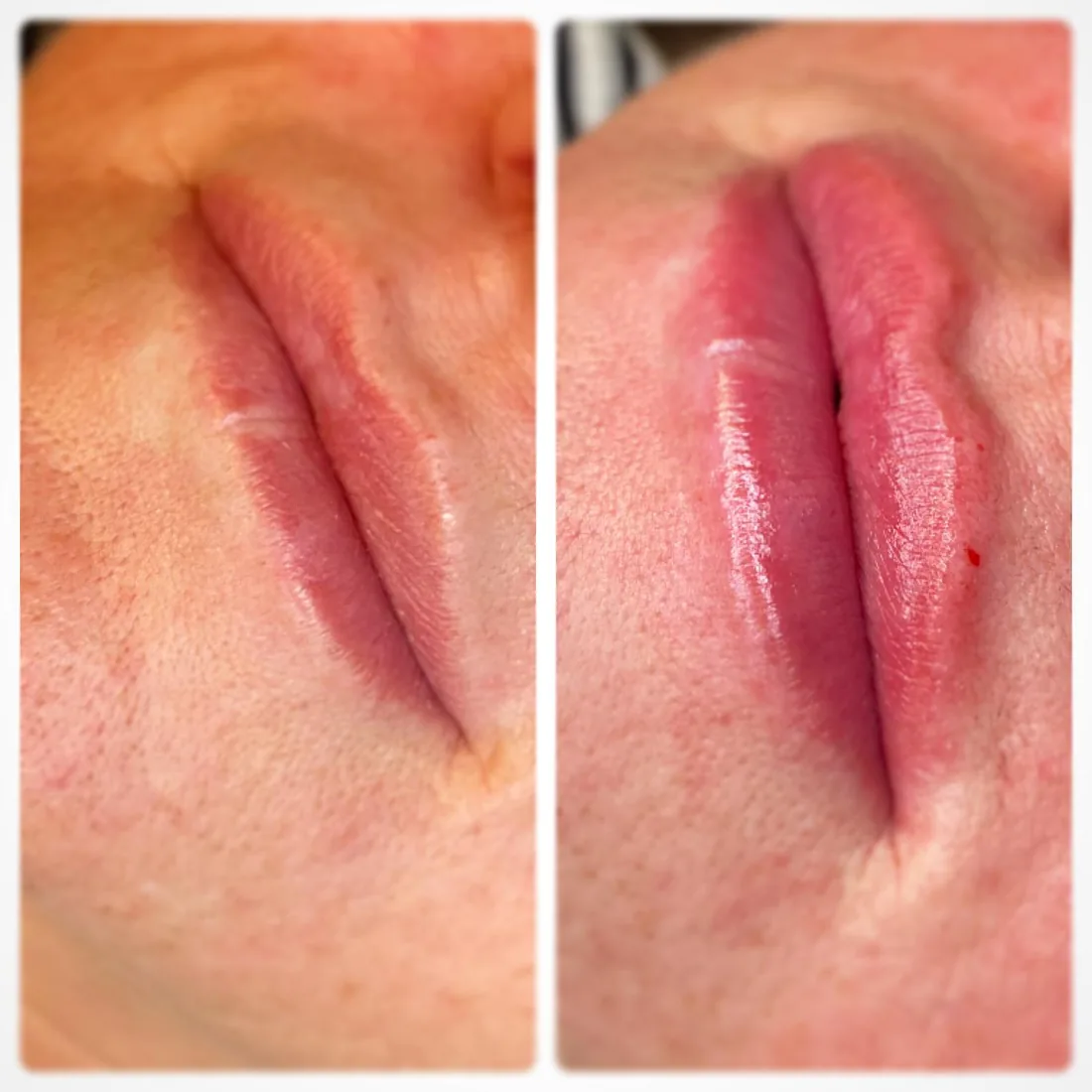 Client comparison photograph 16, published by Refined Medical Aesthetics with permission