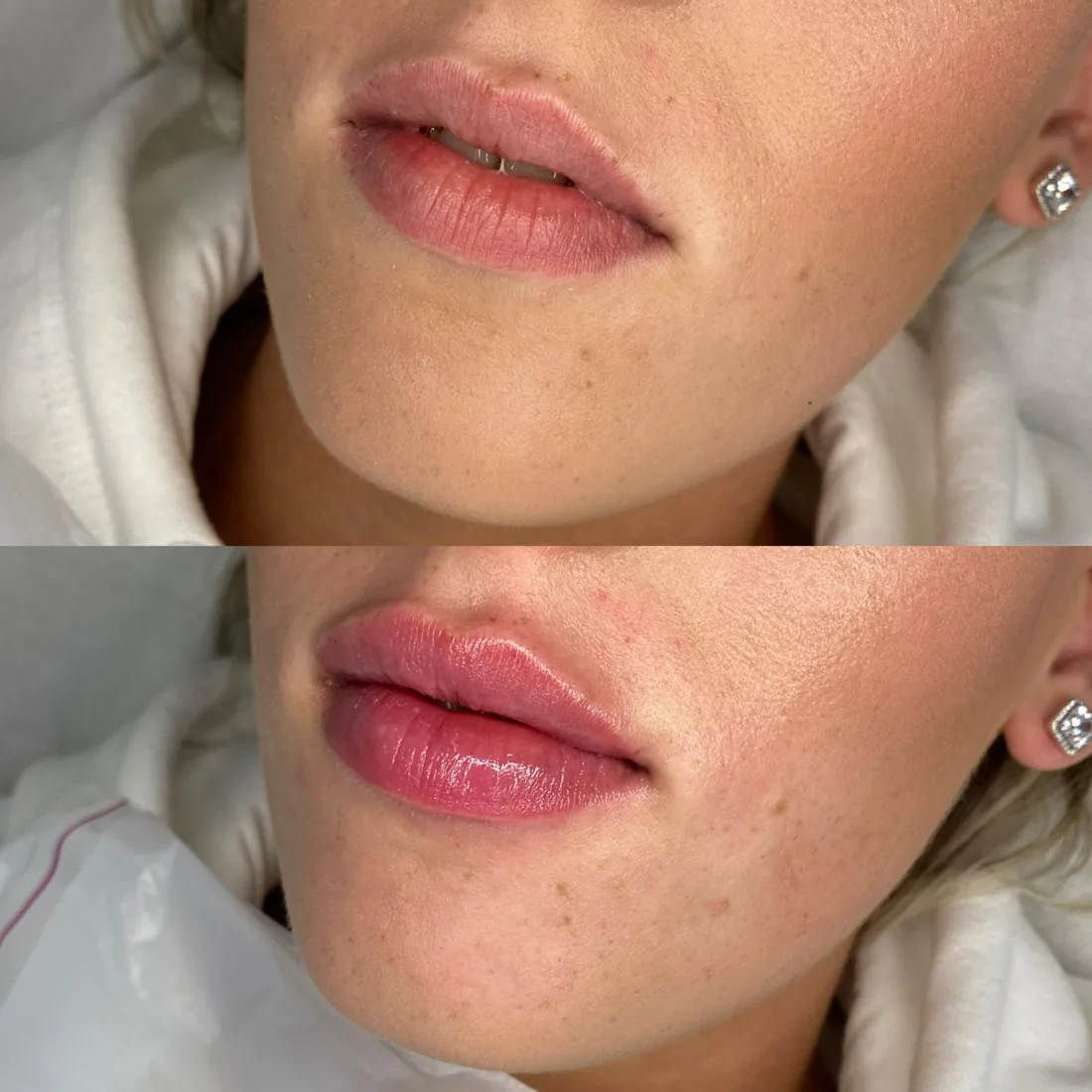 Client comparison photograph 19, published by Refined Medical Aesthetics with permission