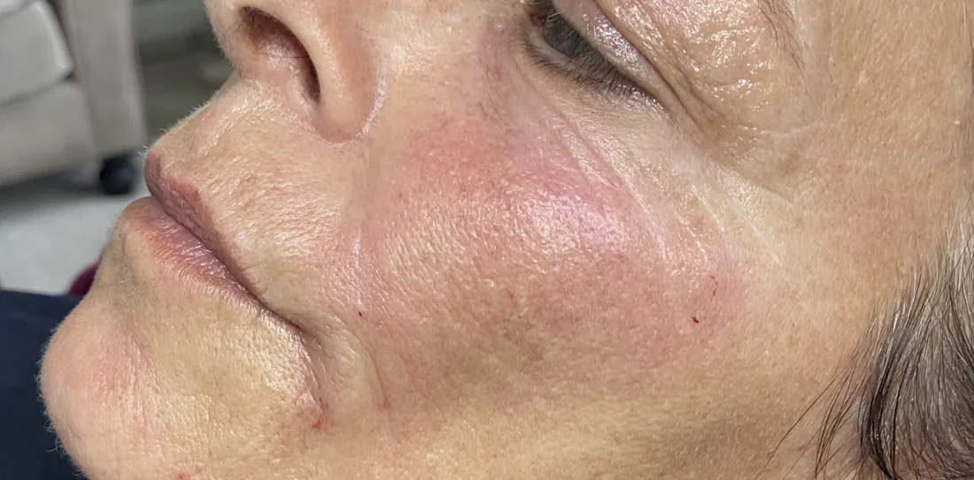 Client comparison photograph 20, published by Refined Medical Aesthetics with permission