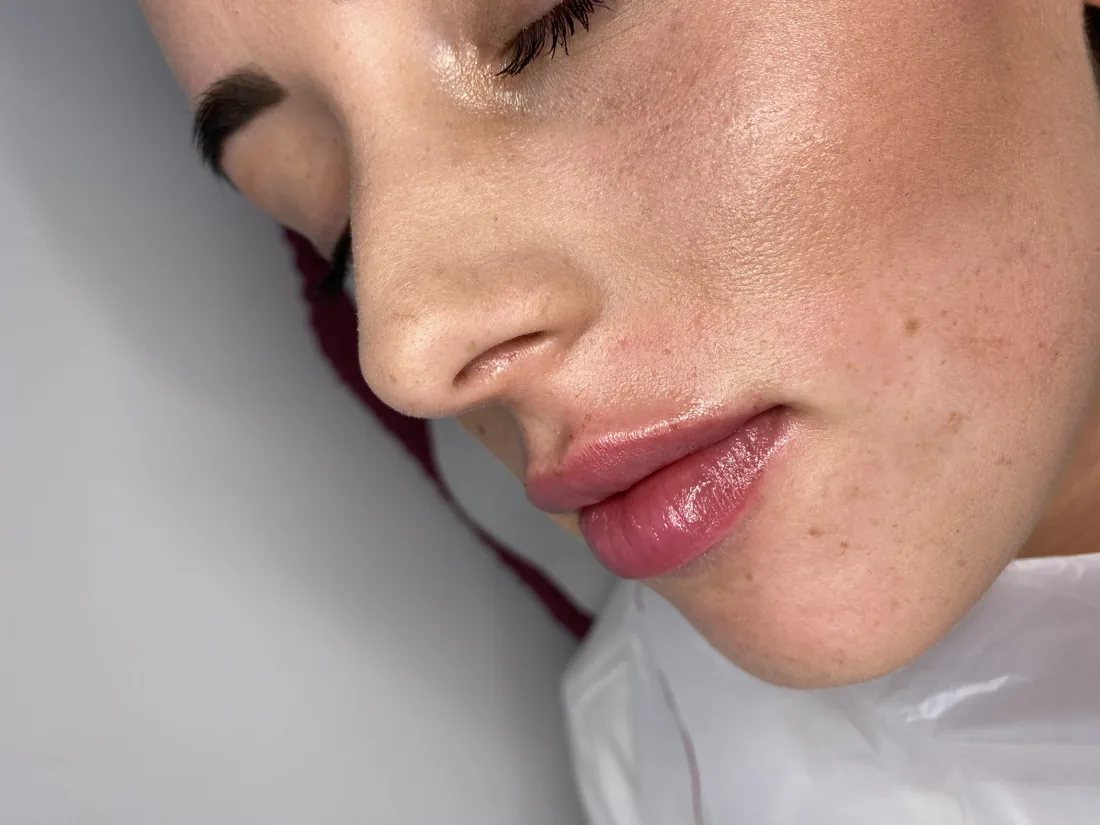 Client comparison photograph 21, published by Refined Medical Aesthetics with permission