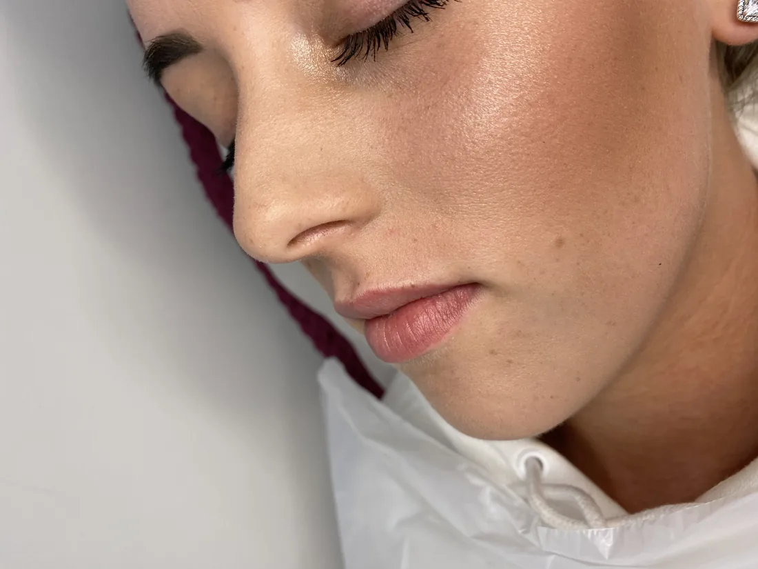 Client comparison photograph 22, published by Refined Medical Aesthetics with permission