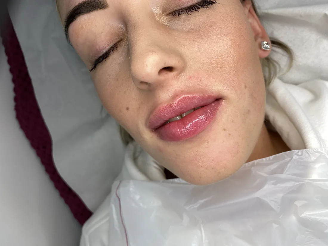 Client comparison photograph 24, published by Refined Medical Aesthetics with permission