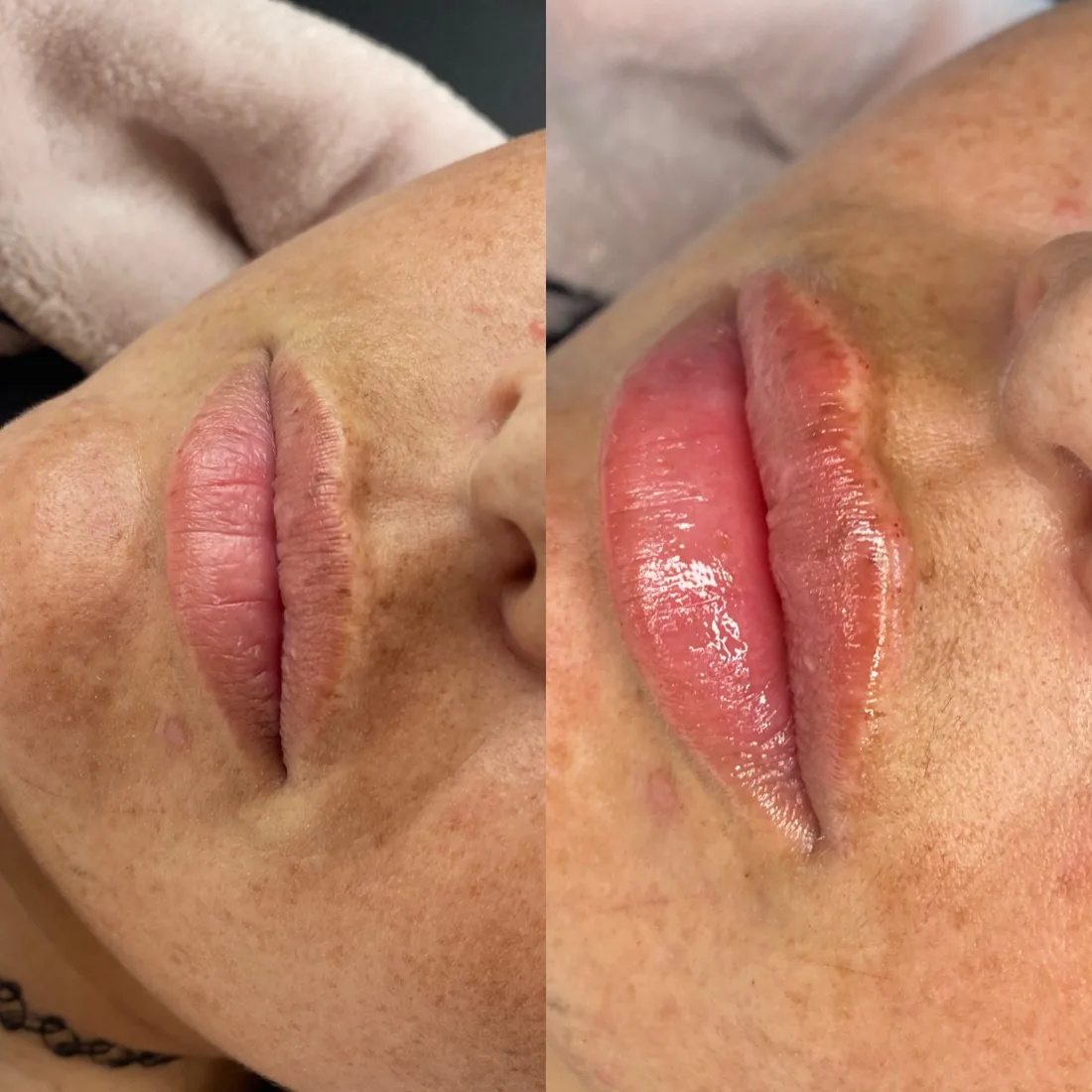 Client comparison photograph 26, published by Refined Medical Aesthetics with permission