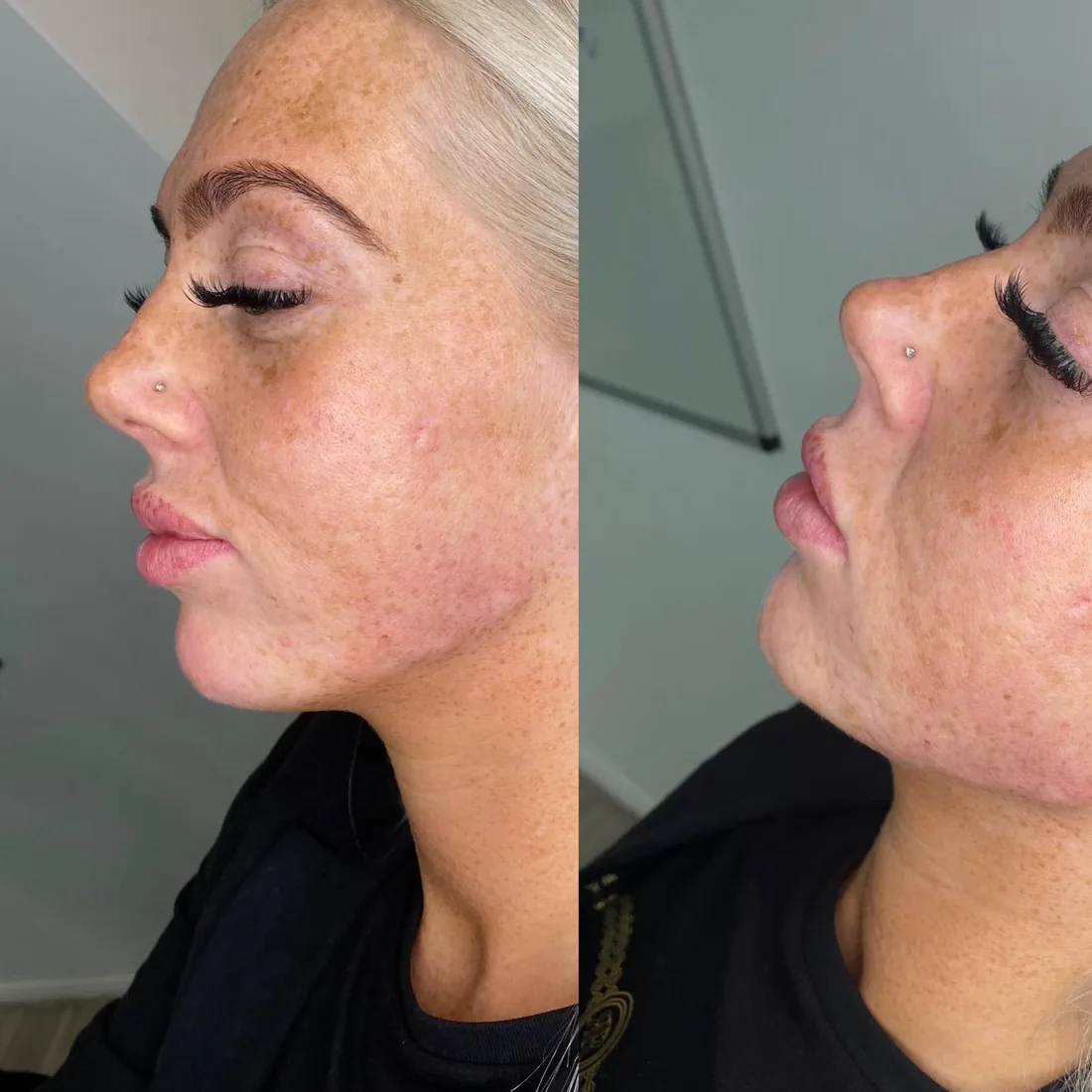 Client comparison photograph 27, published by Refined Medical Aesthetics with permission