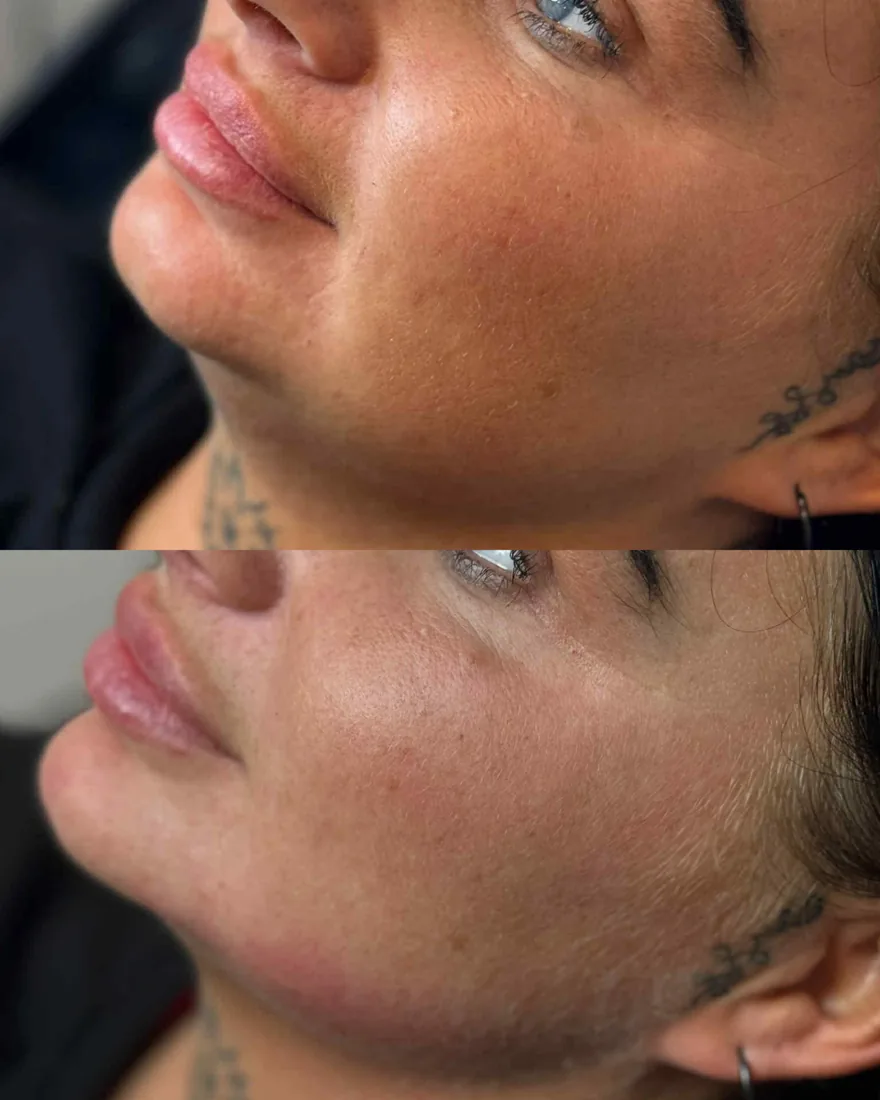 Client comparison photograph 28, published by Refined Medical Aesthetics with permission