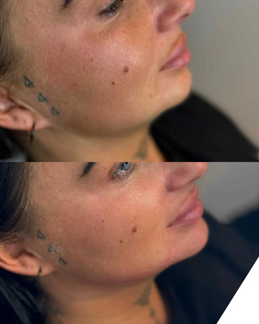 Client comparison photograph 29, published by Refined Medical Aesthetics with permission